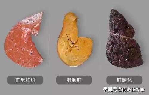 男子酒足饭饱后突发脑干出血，一场突如其来的健康警报