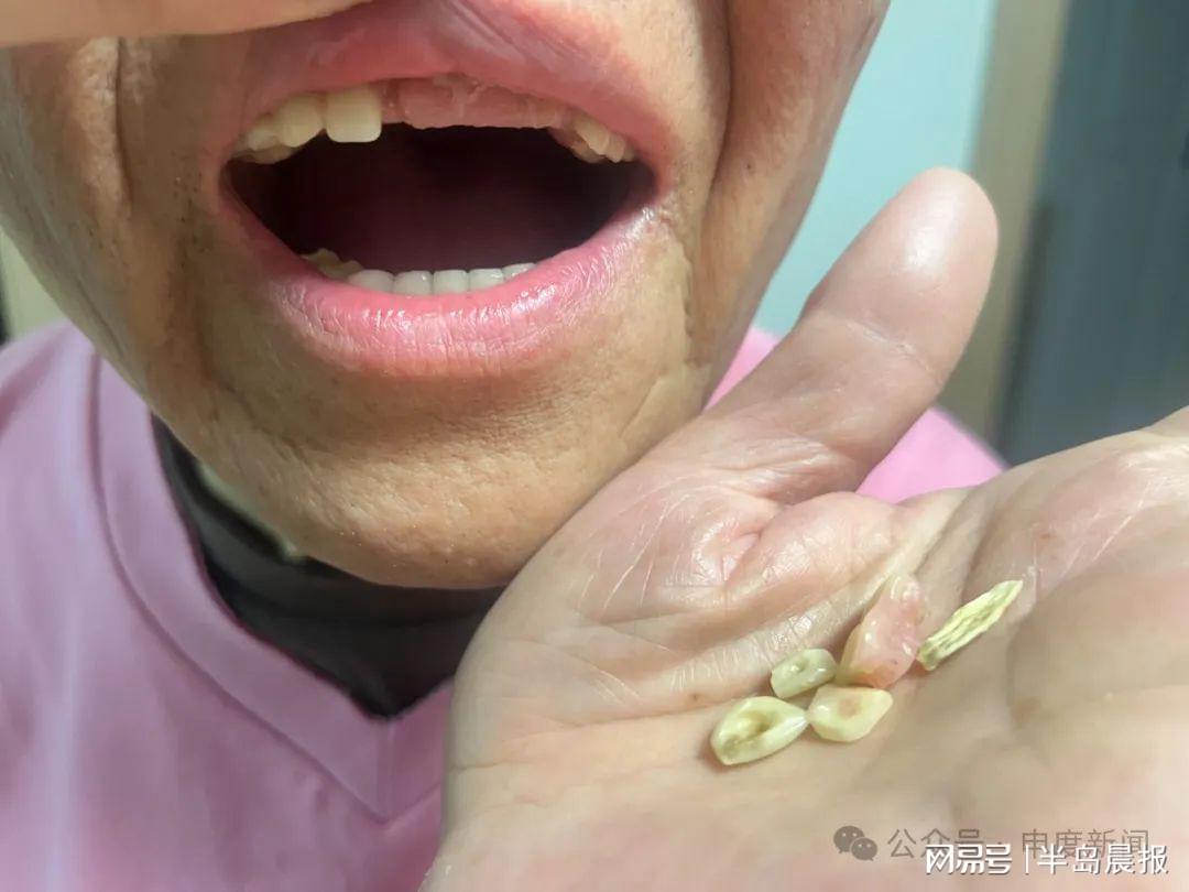 心梗老人看牙记，一次意外的全口拔光与余额的光速消失